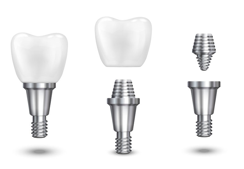 Implante dental en Las Águilas en Madrid